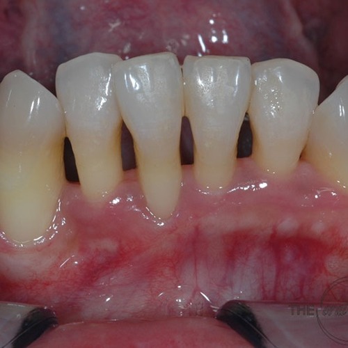 gums receding