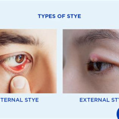 Best Internal Stye In Eye Treatment Reviews