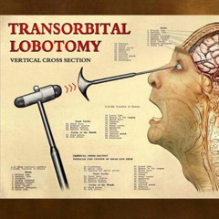 lobotomy