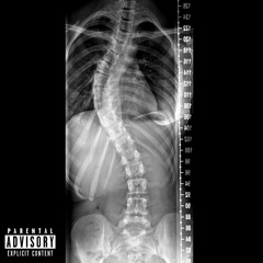 Jayreese (Scoliosis)