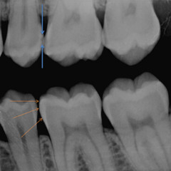 cavities