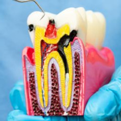 5 Post Root Canal Tips from an Endodontist in San Francisco