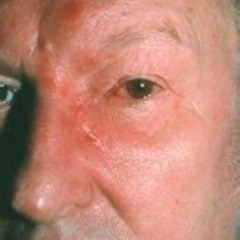 Best Shingles In Eye Treatment Reviews