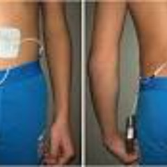 Sacral-Nerve- Stimulation- -Treatment-0TC4Pk