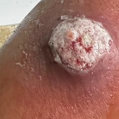 SOMETHING BIT ME