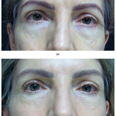 Best Treatment For Hyperpigmentation Under Eyes Reviews