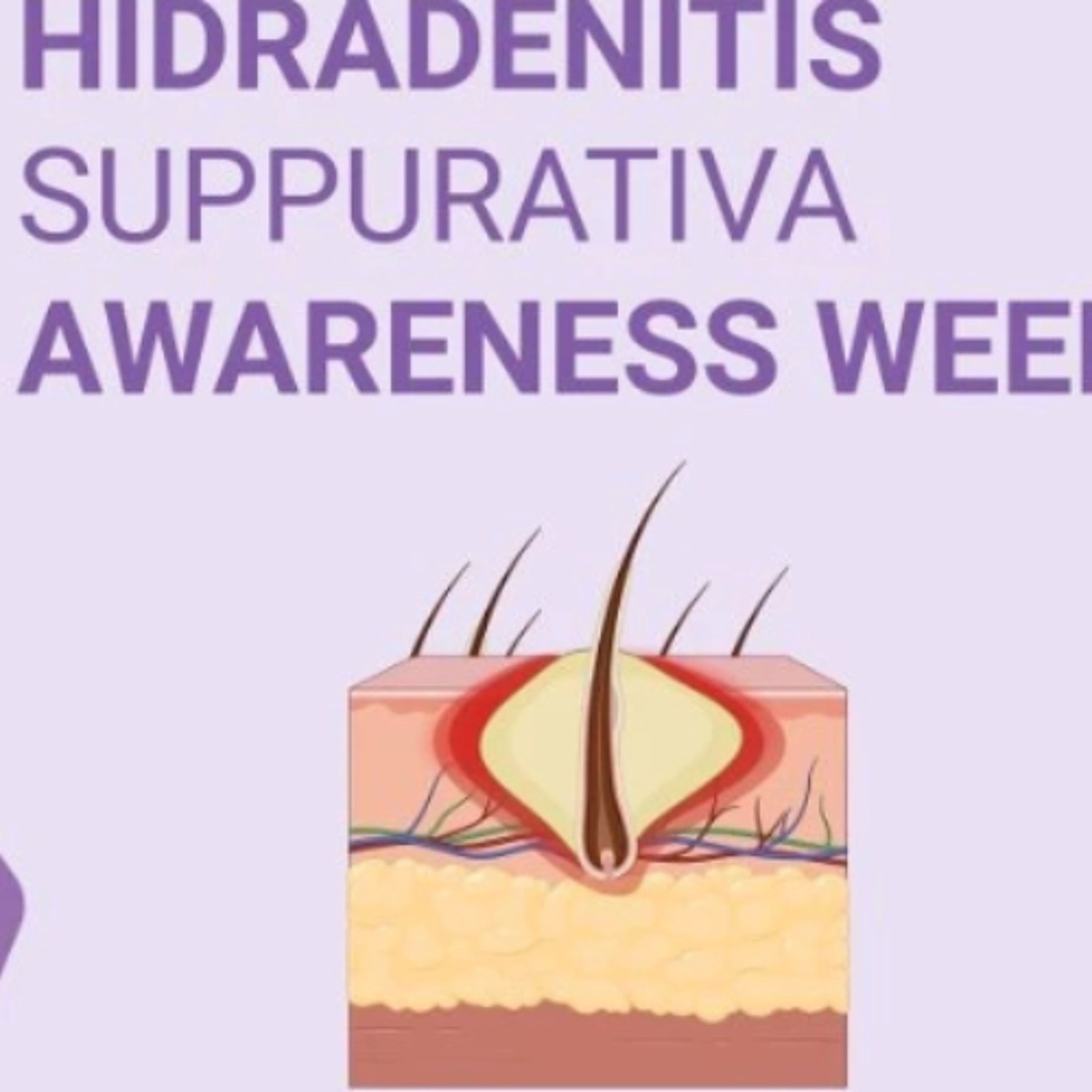 Hidradenitis Suppurativa (HS) Awareness Week, 01–07 June 2026