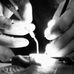 Myringoplasty01