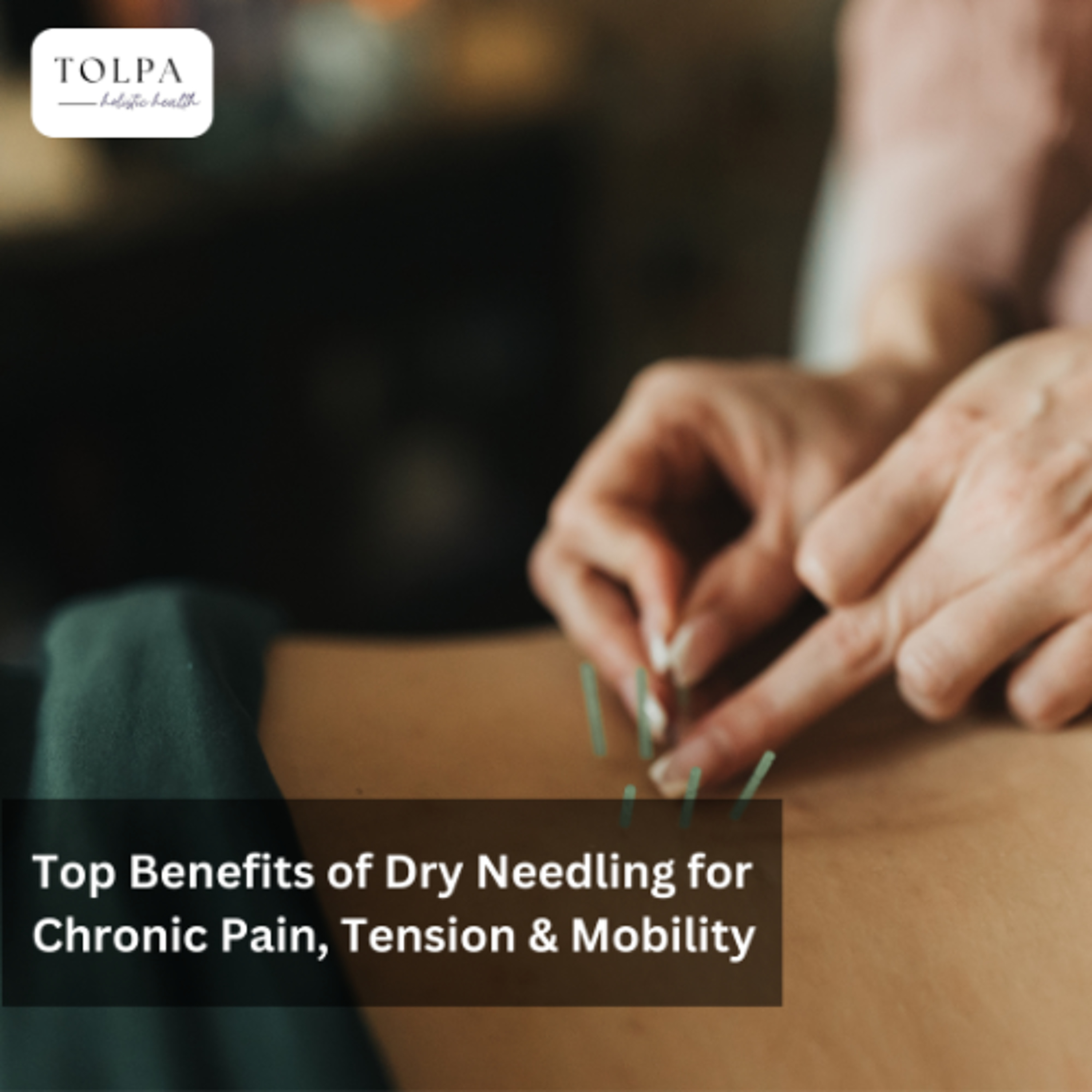 Top Benefits of Dry Needling for Chronic Pain, Tension & Mobility