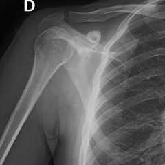 Luxación de hombro derecho