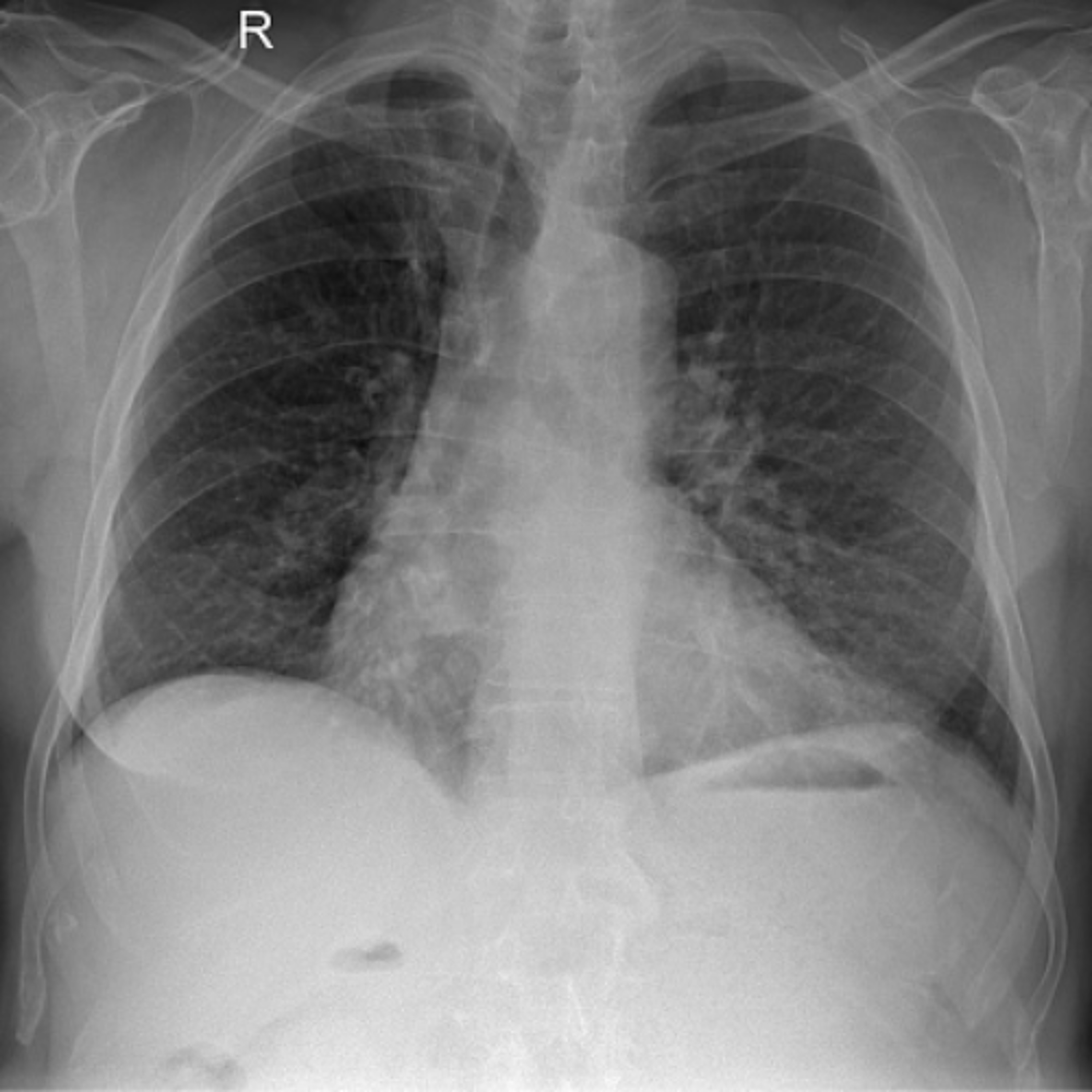 PNEUMOTHORAX episode artwork
