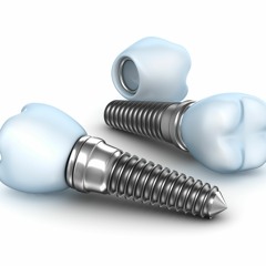 All On Four Dental Implants Restoring Your Smile