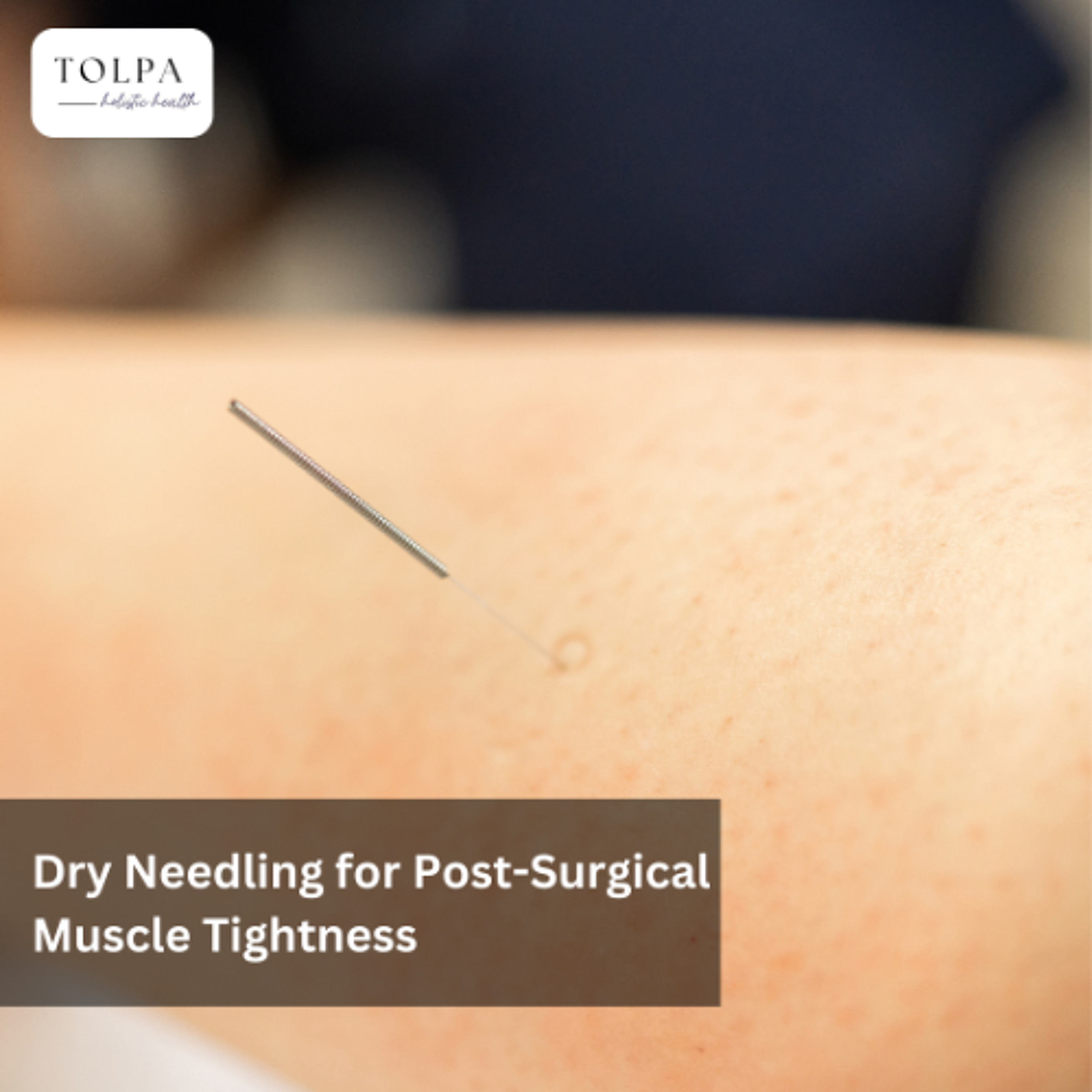 Dry Needling for Post-Surgical Muscle Tightness