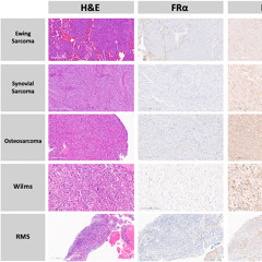 Folate Receptor Beta Found in Pediatric Tumors May Improve Fluorescence-Guided Cancer Surgery