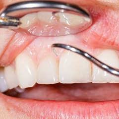 Where can I get my broken tooth repaired in SE, Calgary?