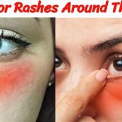 Best Rash Around Eyes Treatment Reviews
