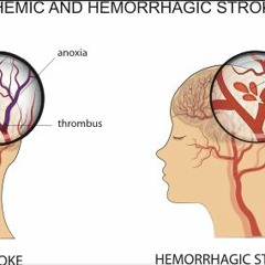 Stroke 2021