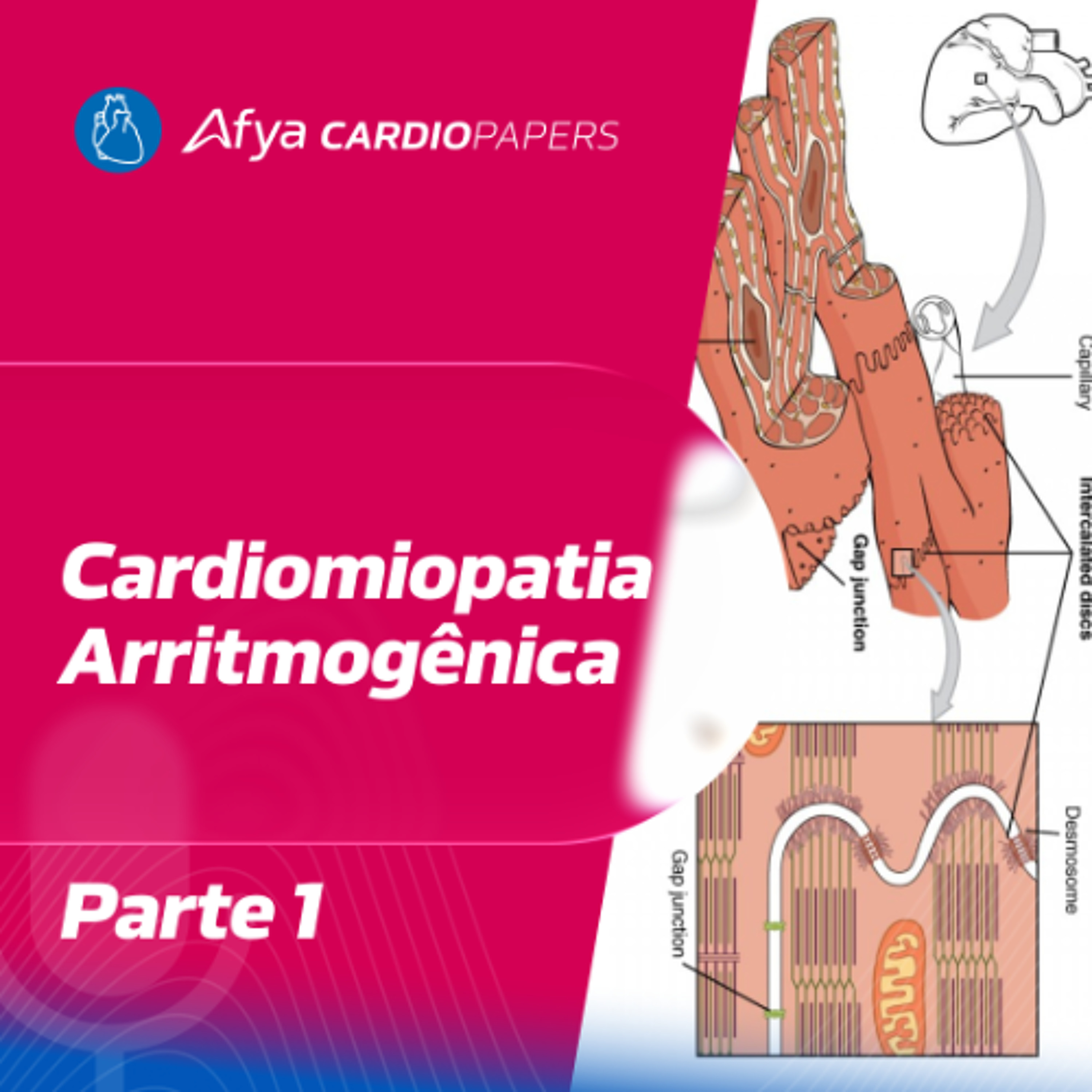Cardiomiopatia Arritmogênica - Parte 1