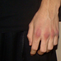 Injury Prone