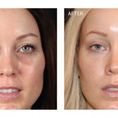 Best Dark Under Eyes Treatment Reviews