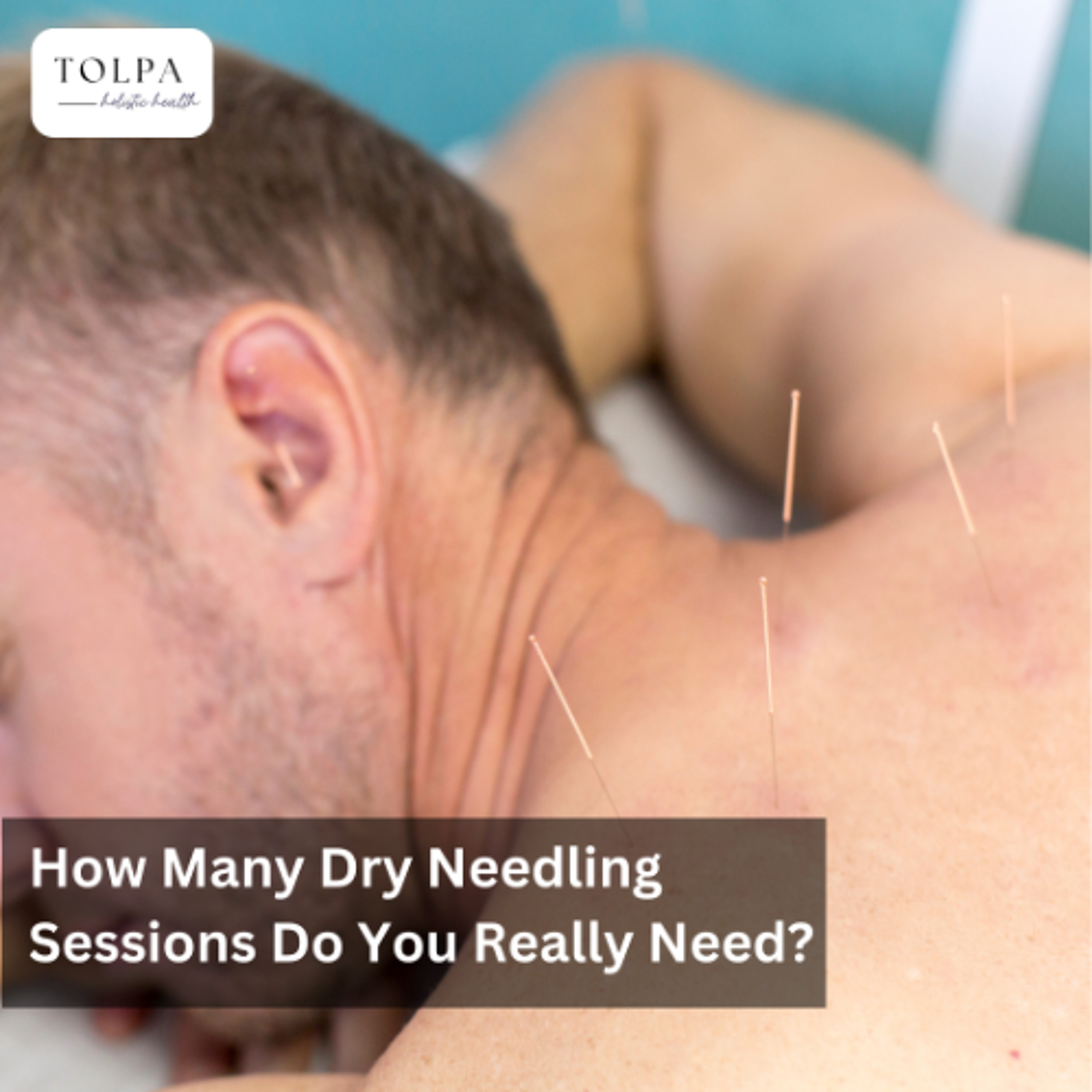 How Many Dry Needling Sessions Do You Really Need?