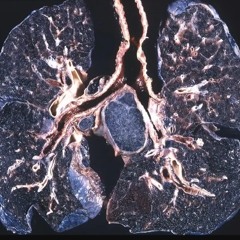 lungzblck