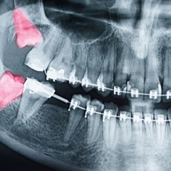 wisdom teeth [prod. v3rg1ll] #dentistcore