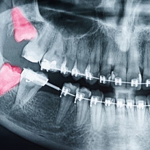 wisdom teeth [prod. v3rg1ll] #dentistcore