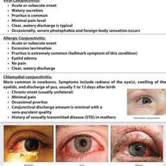 Best Eye Bacterial Conjunctivitis Treatment Reviews