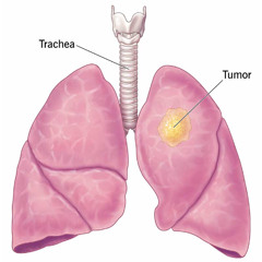 lung cancer @hear @kyodamm