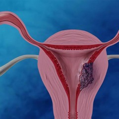 Malignant Endometrial Tumor Treatment | Eliminate Overgrowing Cells & Repair Damaged DNA