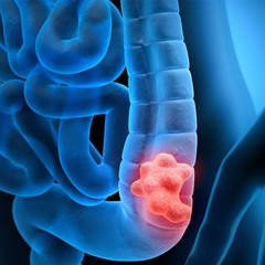Malignant Colon Tumor Care | Reduce Abdominal Discomfort & Heal Your Large Intestines