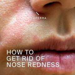 Redness Around Nose -NEODERMA