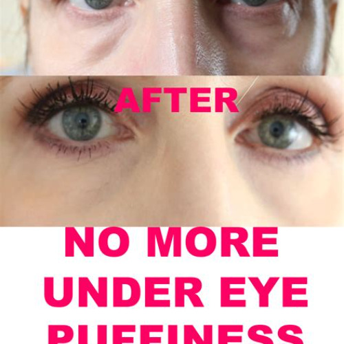 Best Treatment Of Puffiness Under Eyes Reviews