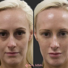 Best Dark Circles Under The Eye Treatment Reviews