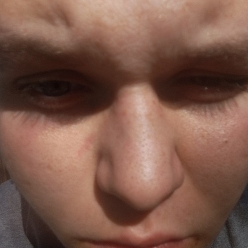 Broken eyes