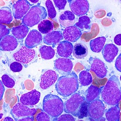 Myelodysplastic
