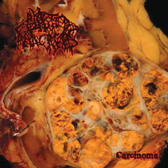 Lymphangiosarcoma