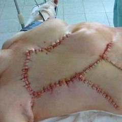 инсульт нежного разума