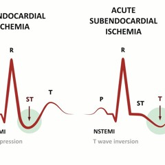 Acute Coronary Syndrome 2021