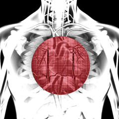 Cardiac Trap Arrest