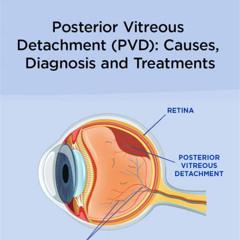 Best Treatment Of Pvd Eye Reviews