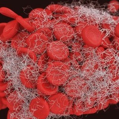 Blood Clot