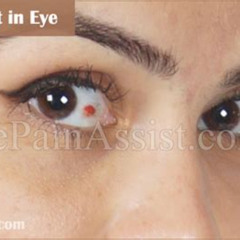 Best Blood Clots In The Eye Treatment Reviews