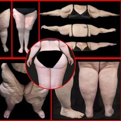 Do I Have Lipedema?