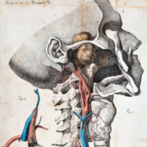 C4 Vertebrae Removal