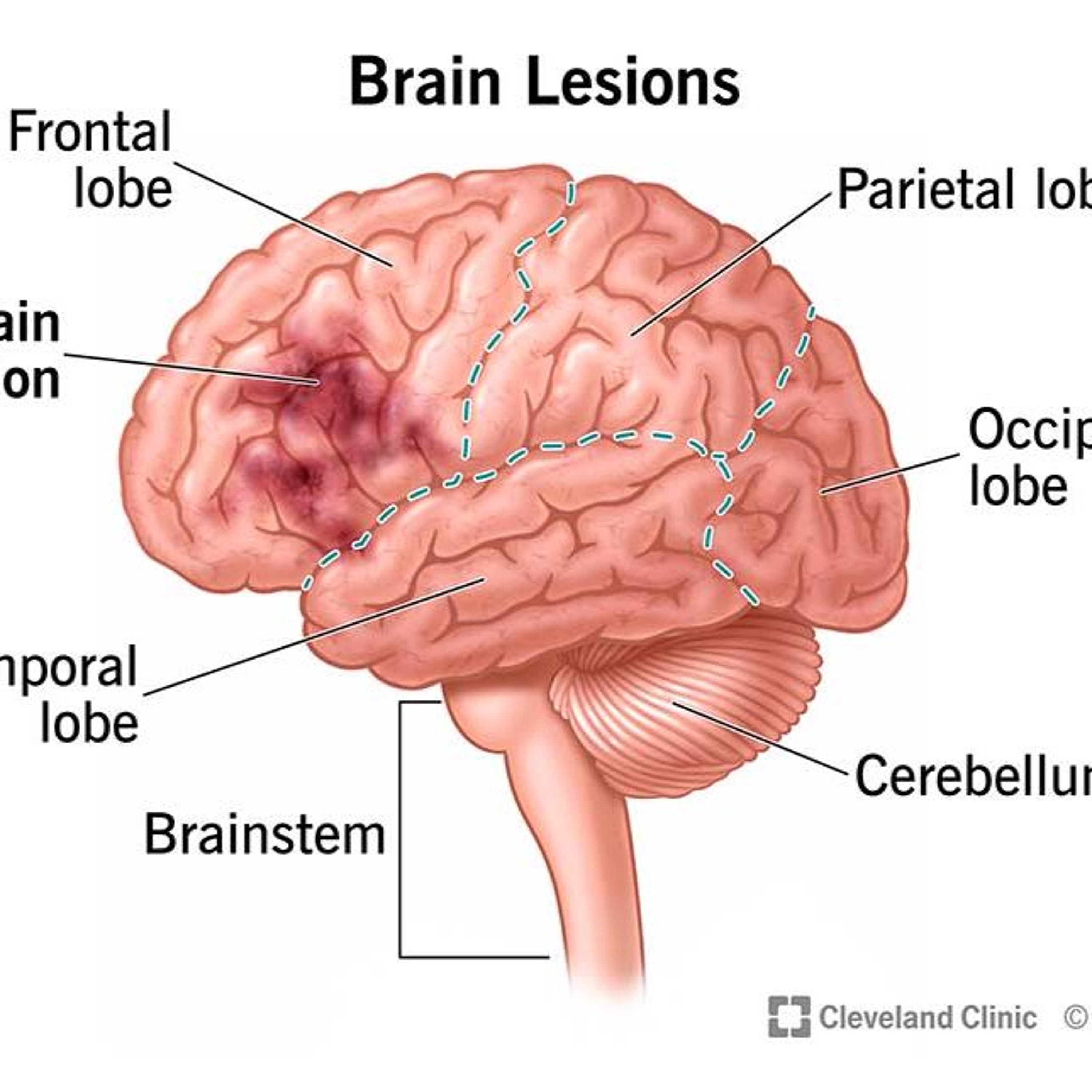 cerveau episode artwork