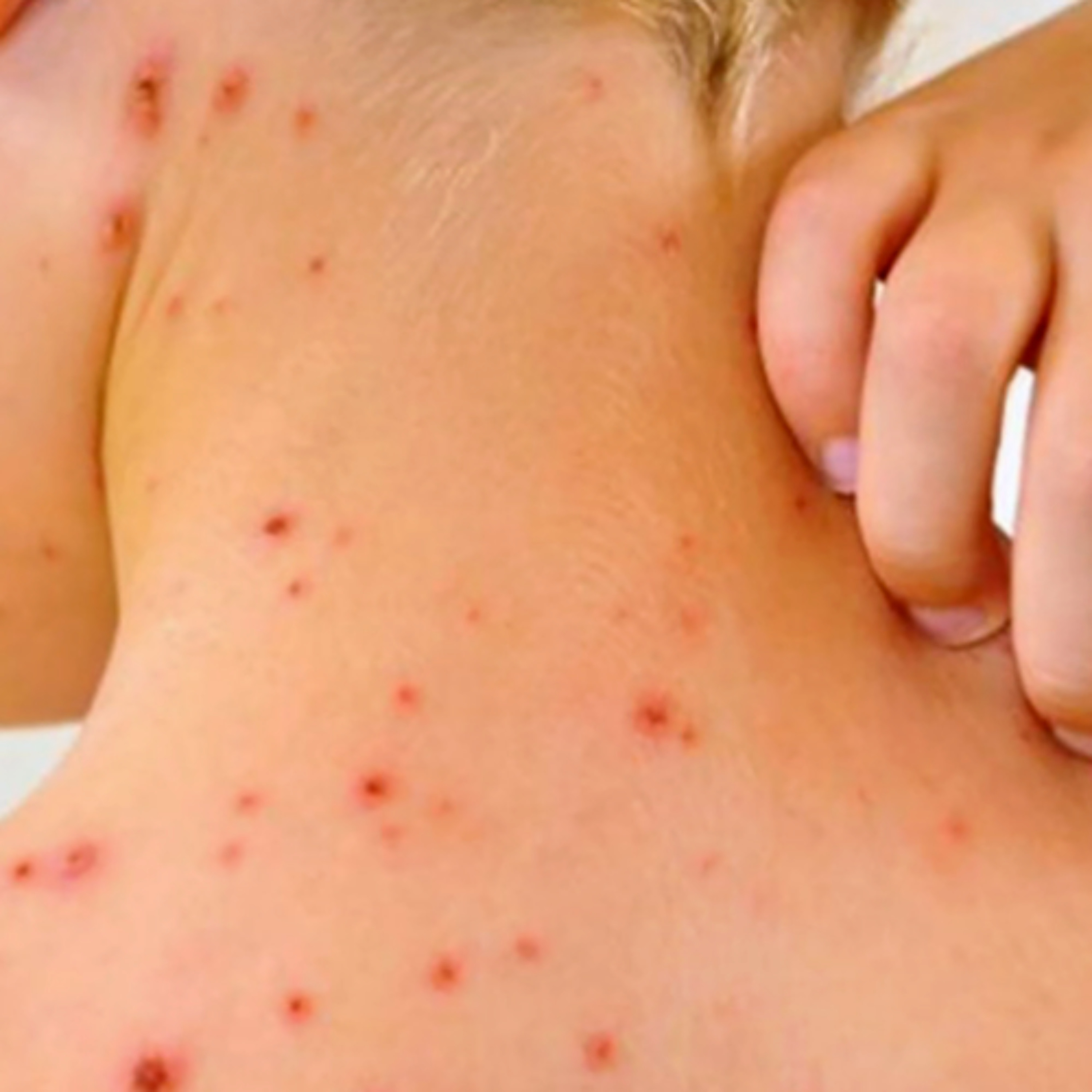 Se reducen los casos de sarampión en México