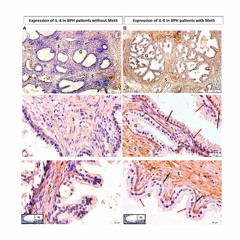 A New Connection Between The Gut Microbiota and Prostate Inflammation in Aging Men