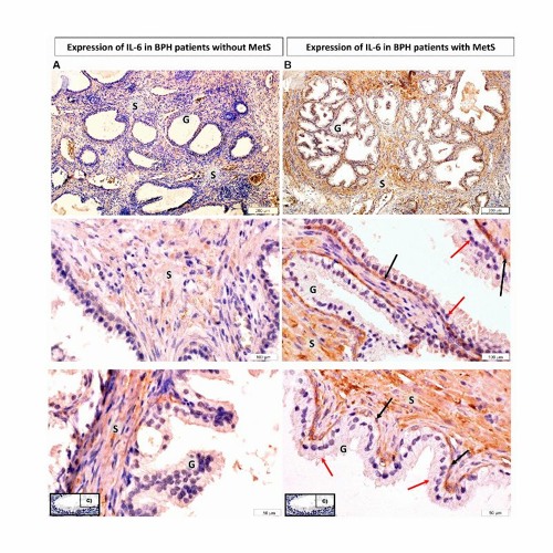 A New Connection Between The Gut Microbiota and Prostate Inflammation in Aging Men
